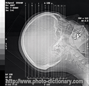 CT Scan - photo/picture definition - CT Scan word and phrase image
