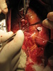 coronary anastomosis - photo/picture definition - coronary anastomosis word and phrase image