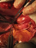 artery bypass surgery - photo/picture definition - artery bypass surgery word and phrase image